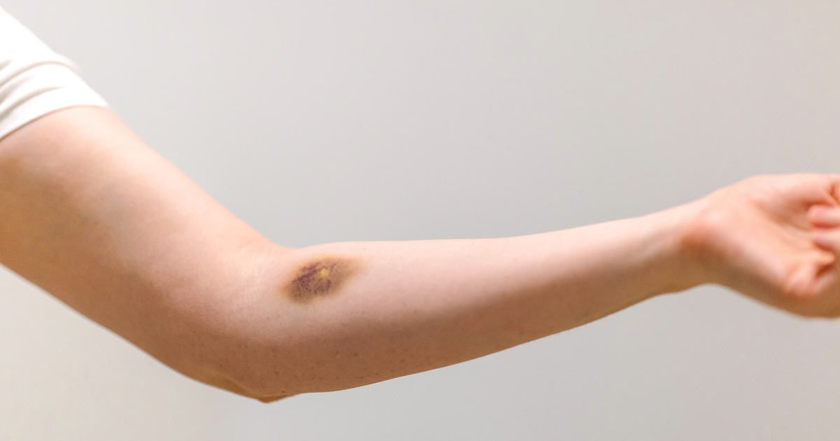 Phlebotomy Now - After Drawing Blood Bruising