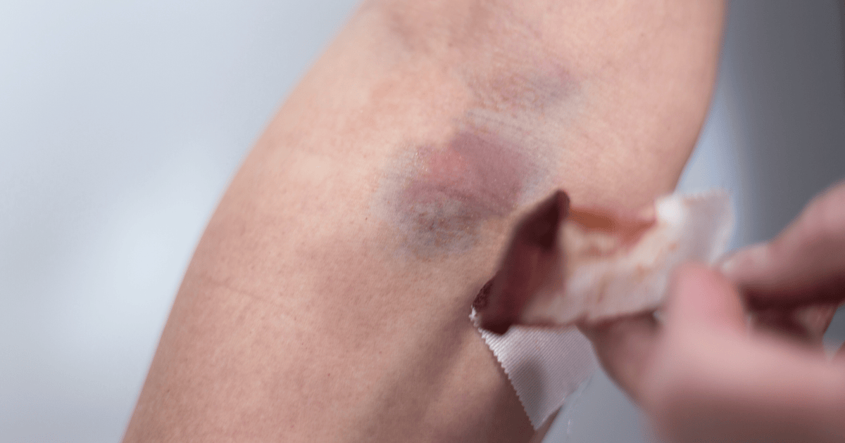 Blood Clot After Blood Draw: Causes, Risks, and Prevention